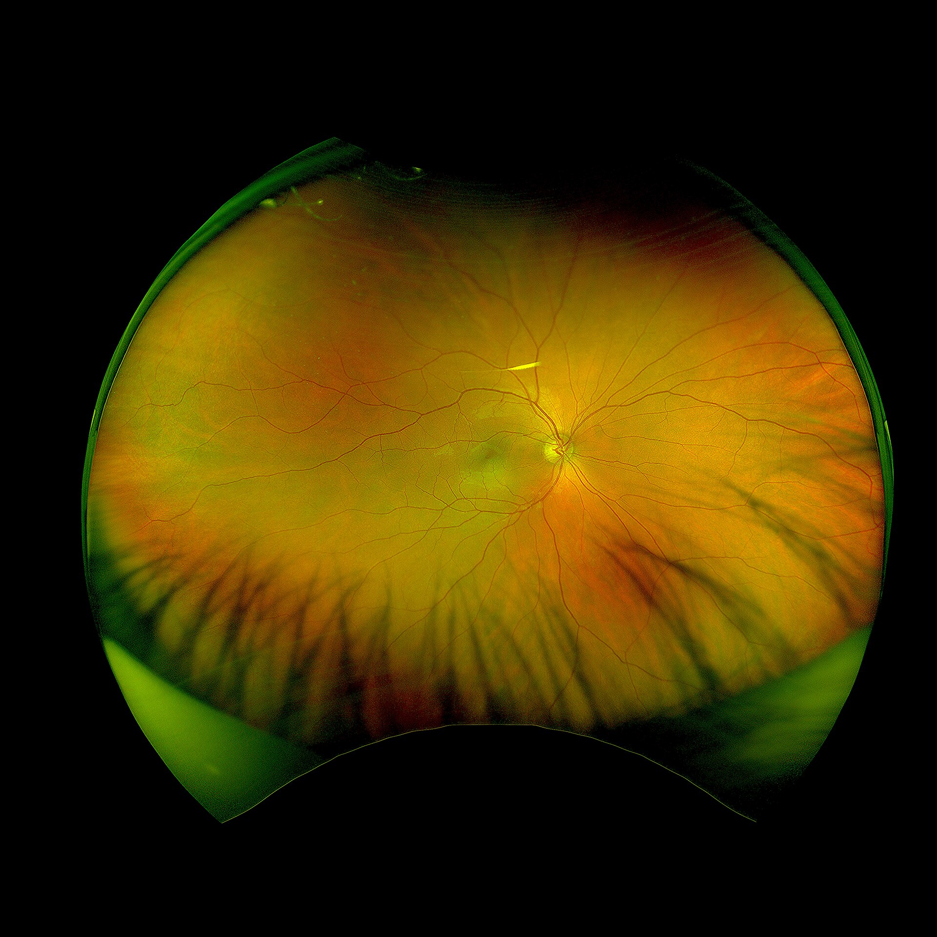 Fondo de ojo